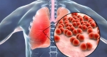 برونشیت ریه (bronchitis) چیست؟