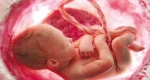 سقط مکرر یعنی چه؟